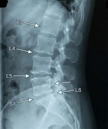 Degenerative Disc Disease