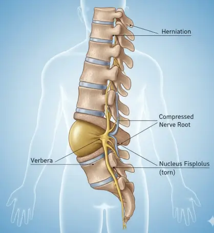 Herniated discs