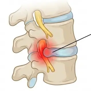 Illustration showing radiculopathy with nerve root compression in the spine