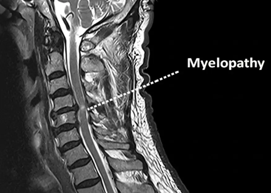Spinal Myelopathy