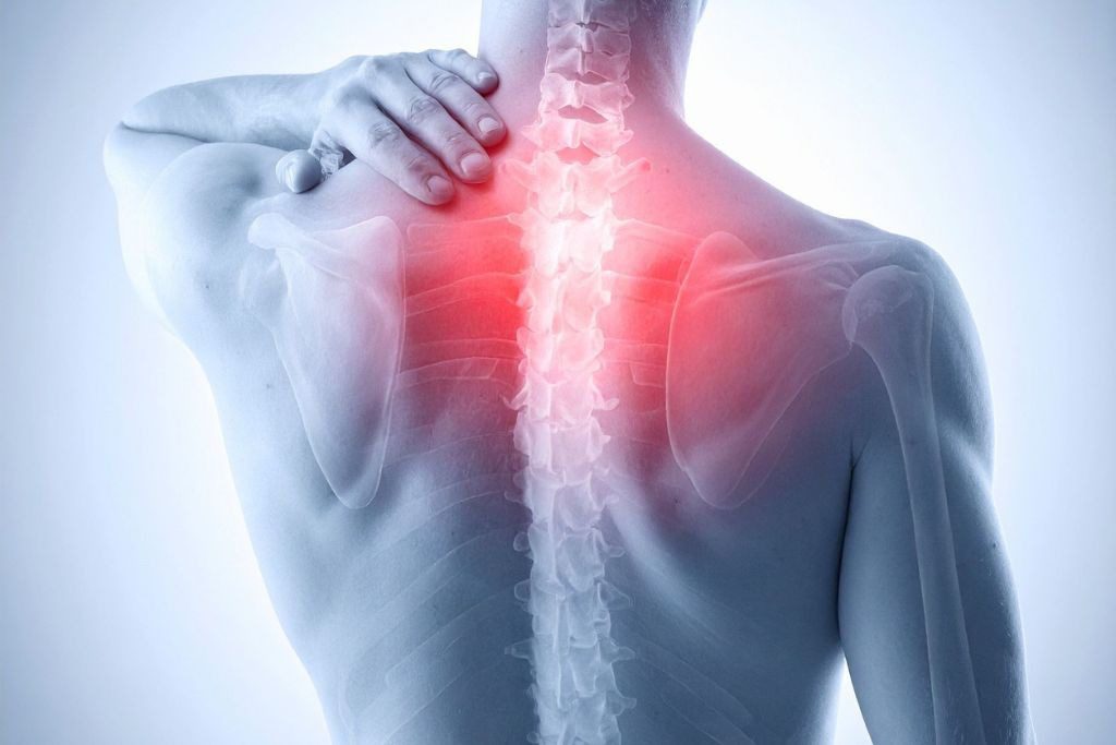 3 Months After Spinal Fusion