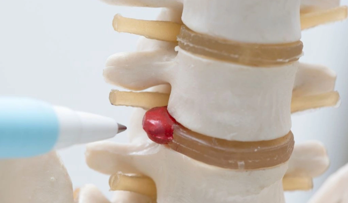 artificial disc replacement