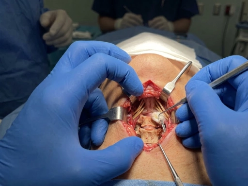 cervical spinal fusion recovery